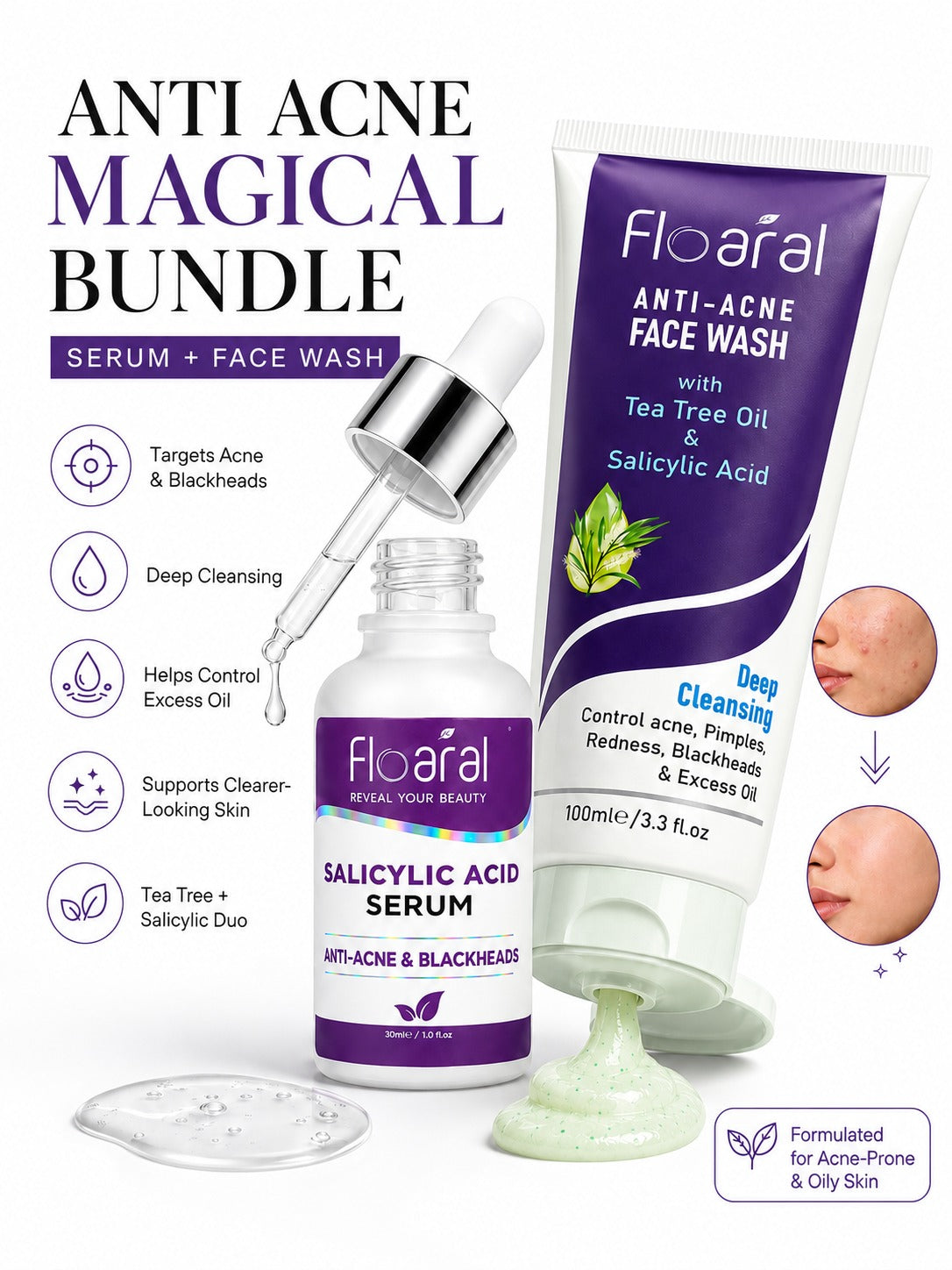 Anti-Acne magical bundle